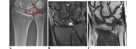 ulnocarpal impaction test|ulnar impaction syndrome diagnosis.